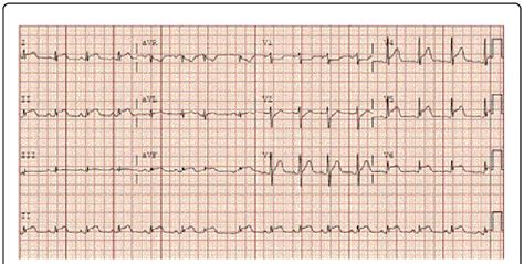 hypokinesia of lv|mild apical and septal hypokinesis.